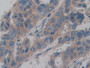 DAB staining on IHC-P; Samples: Human Breast cancer Tissue; Primary Ab: 10µg/ml Rabbit Anti-Human AMELX Antibody Second Ab: 2µg/mL HRP-Linked Caprine Anti-Rabbit IgG Polyclonal Antibody