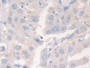 DAB staining on IHC-P; Samples: Human Breast cancer Tissue; Primary Ab: 30µg/ml Rabbit Anti-Human AOAH Antibody Second Ab: 2µg/mL HRP-Linked Caprine Anti-Rabbit IgG Polyclonal Antibody