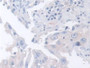 DAB staining on IHC-P; Samples: Human Breast cancer Tissue; Primary Ab: 30µg/ml Rabbit Anti-Human ARPC2 Antibody Second Ab: 2µg/mL HRP-Linked Caprine Anti-Rabbit IgG Polyclonal Antibody