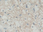 DAB staining on IHC-P; Samples: Human Glioma Tissue; Primary Ab: 30µg/ml Rabbit Anti-Human BLVRB Antibody Second Ab: 2µg/mL HRP-Linked Caprine Anti-Rabbit IgG Polyclonal Antibody