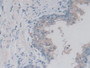 DAB staining on IHC-P; Samples: Human Prostate Tissue; Primary Ab: 30µg/ml Rabbit Anti-Human LACTb Antibody Second Ab: 2µg/mL HRP-Linked Caprine Anti-Rabbit IgG Polyclonal Antibody