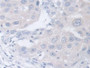 DAB staining on IHC-P; Samples: Human Breast cancer Tissue; Primary Ab: 30µg/ml Rabbit Anti-Human CHI3L2 Antibody Second Ab: 2µg/mL HRP-Linked Caprine Anti-Rabbit IgG Polyclonal Antibody