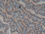 DAB staining on IHC-P; Samples: Human Thyroid cancer Tissue; Primary Ab: 20µg/ml Rabbit Anti-Rat BGN Antibody Second Ab: 2µg/mL HRP-Linked Caprine Anti-Rabbit IgG Polyclonal Antibody