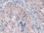 DAB staining on IHC-P; Samples: Human Breast cancer Tissue; Primary Ab: 10µg/ml Rabbit Anti-Human FcgRT Antibody Second Ab: 2µg/mL HRP-Linked Caprine Anti-Rabbit IgG Polyclonal Antibody