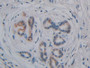 DAB staining on IHC-P; Samples: Human Pancreatic cancer Tissue; Primary Ab: 10µg/ml Rabbit Anti-Human GPLD1 Antibody Second Ab: 2µg/mL HRP-Linked Caprine Anti-Rabbit IgG Polyclonal Antibody