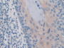 DAB staining on IHC-P; Samples: Human Skin cancer Tissue; Primary Ab: 10µg/ml Rabbit Anti-Human IREB2 Antibody Second Ab: 2µg/mL HRP-Linked Caprine Anti-Rabbit IgG Polyclonal Antibody