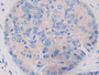 DAB staining on IHC-P; Samples: Human Prostate cancer Tissue; Primary Ab: 30µg/ml Rabbit Anti-Human LRRFIP1 Antibody Second Ab: 2µg/mL HRP-Linked Caprine Anti-Rabbit IgG Polyclonal Antibody