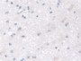 DAB staining on IHC-P; Samples: Human Glioma Tissue; Primary Ab: 30µg/ml Rabbit Anti-Human MPI Antibody Second Ab: 2µg/mL HRP-Linked Caprine Anti-Rabbit IgG Polyclonal Antibody