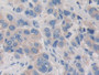 DAB staining on IHC-P; Samples: Human Breast cancer Tissue; Primary Ab: 10µg/ml Rabbit Anti-Human PDHX Antibody Second Ab: 2µg/mL HRP-Linked Caprine Anti-Rabbit IgG Polyclonal Antibody