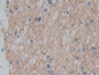 DAB staining on IHC-P; Samples: Human Glioma Tissue; Primary Ab: 10µg/ml Rabbit Anti-Human PLXNA1 Antibody Second Ab: 2µg/mL HRP-Linked Caprine Anti-Rabbit IgG Polyclonal Antibody