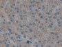 DAB staining on IHC-P; Samples: Human Liver cancer Tissue; Primary Ab: 10µg/ml Rabbit Anti-Human RAGE Antibody Second Ab: 2µg/mL HRP-Linked Caprine Anti-Rabbit IgG Polyclonal Antibody