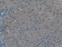 DAB staining on fromalin fixed paraffin- embedded liver cancer tissue)