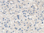 DAB staining on IHC-P; Samples: Human Glioma Tissue; Primary Ab: 20µg/ml Rabbit Anti-Human SCARA5 Antibody Second Ab: 2µg/mL HRP-Linked Caprine Anti-Rabbit IgG Polyclonal Antibody