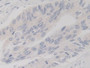DAB staining on IHC-P; Samples: Human Colorectal cancer Tissue;  Primary Ab: 30µg/ml Rabbit Anti-Hum