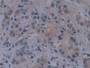 DAB staining on IHC-P; Samples: Human Prostate cancer Tissue; Primary Ab: 10µg/ml Rabbit Anti-Human TICAM1 Antibody Second Ab: 2µg/mL HRP-Linked Caprine Anti-Rabbit IgG Polyclonal Antibody