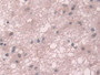 DAB staining on IHC-P; Samples: Human Glioma Tissue; Primary Ab: 10µg/ml Rabbit Anti-Human TKT Antibody Second Ab: 2µg/mL HRP-Linked Caprine Anti-Rabbit IgG Polyclonal Antibody