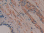 DAB staining on IHC-P; Samples: Human Prostate cancer Tissue; Primary Ab: 10µg/ml Rabbit Anti-Human TTK Antibody Second Ab: 2µg/mL HRP-Linked Caprine Anti-Rabbit IgG Polyclonal Antibody