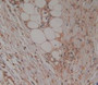 DAB staining on IHC-P; Samples:Human Skin Cancer Tissue.