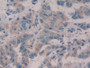 DAB staining on IHC-P; Samples: Human Breast cancer Tissue;  Primary Ab: 10µg/ml Rabbit Anti-Human W