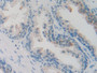 DAB staining on IHC-P; Samples: Human Prostate Tissue; Primary Ab: 10µg/ml Rabbit Anti-Human SCGN Antibody Second Ab: 2µg/mL HRP-Linked Caprine Anti-Rabbit IgG Polyclonal Antibody