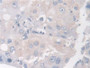DAB staining on IHC-P; Samples: Human Breast cancer Tissue; Primary Ab: 30µg/ml Rabbit Anti-Human BCAR1 Antibody Second Ab: 2µg/mL HRP-Linked Caprine Anti-Rabbit IgG Polyclonal Antibody
