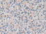 DAB staining on IHC-P; Samples: Human Prostate cancer Tissue; Primary Ab: 10µg/ml Rabbit Anti-Human TOR1A Antibody Second Ab: 2µg/mL HRP-Linked Caprine Anti-Rabbit IgG Polyclonal Antibody