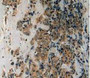 DAB staining on IHC-P; Samples: Human Breast Cancer Tissue.