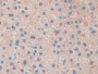 DAB staining on IHC-P; Samples: Human Liver cancer Tissue; Primary Ab: 30µg/ml Rabbit Anti-Human GLDC Antibody Second Ab: 2µg/mL HRP-Linked Caprine Anti-Rabbit IgG Polyclonal Antibody