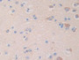 DAB staining on fromalin fixed paraffin- embedded stomach cancer tissue)