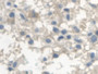 DAB staining on IHC-P; Samples: Human Glioma Tissue; Primary Ab: 20µg/ml Rabbit Anti-Human ATP1a1 Antibody Second Ab: 2µg/mL HRP-Linked Caprine Anti-Rabbit IgG Polyclonal Antibody