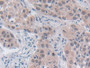 DAB staining on IHC-P; Samples: Human Lung cancer Tissue; Primary Ab: 30µg/ml Rabbit Anti-Human SRY Antibody Second Ab: 2µg/mL HRP-Linked Caprine Anti-Rabbit IgG Polyclonal Antibody