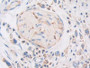 DAB staining on IHC-P; Samples: Human Stomach cancer Tissue; Primary Ab: 20µg/ml Rabbit Anti-Human PZP Antibody Second Ab: 2µg/mL HRP-Linked Caprine Anti-Rabbit IgG Polyclonal Antibody