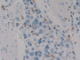 DAB staining on IHC-P; Samples: Human Stomach cancer Tissue; Primary Ab: 10µg/ml Rabbit Anti-Human HIF1aN Antibody Second Ab: 2µg/mL HRP-Linked Caprine Anti-Rabbit IgG Polyclonal Antibody