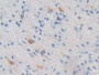 DAB staining on IHC-P; Samples: Human Glioma Tissue; Primary Ab: 10µg/ml Rabbit Anti-Human PRKAb2 Antibody Second Ab: 2µg/mL HRP-Linked Caprine Anti-Rabbit IgG Polyclonal Antibody