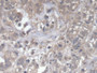 DAB staining on IHC-P; Samples: Human Breast cancer Tissue; Primary Ab: 20µg/ml Rabbit Anti-Human DOCK4 Antibody Second Ab: 2µg/mL HRP-Linked Caprine Anti-Rabbit IgG Polyclonal Antibody