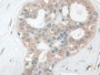 DAB staining on IHC-P; Samples: Human Breast cancer Tissue;  Primary Ab: 10µg/ml Rabbit Anti-Human C