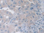 DAB staining on IHC-P; Samples: Human Breast cancer Tissue)