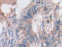 DAB staining on IHC-P; Samples: Human Colorectal cancer Tissue; Primary Ab: 30µg/ml Rabbit Anti-Human OAS2 Antibody Second Ab: 2µg/mL HRP-Linked Caprine Anti-Rabbit IgG Polyclonal Antibody