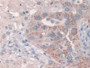 DAB staining on IHC-P; Samples: Human Breast cancer Tissue; Primary Ab: 10µg/ml Rabbit Anti-Human Grb10 Antibody Second Ab: 2µg/mL HRP-Linked Caprine Anti-Rabbit IgG Polyclonal Antibody