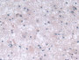 DAB staining on IHC-P; Samples: Human Glioma Tissue.