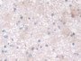 DAB staining on IHC-P; Samples: Human Glioma Tissue; Primary Ab: 10µg/ml Rabbit Anti-Human CRABP2 Antibody Second Ab: 2µg/mL HRP-Linked Caprine Anti-Rabbit IgG Polyclonal Antibody