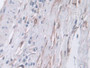 DAB staining on IHC-P; Samples: Human Prostate cancer Tissue; Primary Ab: 10µg/ml Rabbit Anti-Human CPA4 Antibody Second Ab: 2µg/mL HRP-Linked Caprine Anti-Rabbit IgG Polyclonal Antibody