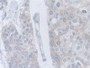 DAB staining on IHC-P; Samples: Human Prostate cancer Tissue; Primary Ab: 30µg/ml Rabbit Anti-Human CRLF1 Antibody Second Ab: 2µg/mL HRP-Linked Caprine Anti-Rabbit IgG Polyclonal Antibody