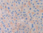 DAB staining on IHC-P; Samples: Human Liver cancer Tissue)