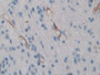 DAB staining on IHC-P; Samples: Human Glioma Tissue; Primary Ab: 10µg/ml Rabbit Anti-Human FLNb Antibody Second Ab: 2µg/mL HRP-Linked Caprine Anti-Rabbit IgG Polyclonal Antibody