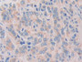 DAB staining on IHC-P; Samples: Human Prostate cancer Tissue; Primary Ab: 10µg/ml Rabbit Anti-Human IL1z Antibody Second Ab: 2µg/mL HRP-Linked Caprine Anti-Rabbit IgG Polyclonal Antibody