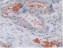 DAB staining on IHC-P; Samples: Human Rectum Cancer Tissue.