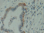DAB staining on IHC-P; Samples: Human Pancreas cancer Tissue;  Primary Ab: 10µg/ml Rabbit Anti-Human