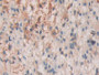 DAB staining on IHC-P; Samples: Human Glioma Tissue; Primary Ab: 10µg/ml Rabbit Anti-Human SHC3 Antibody Second Ab: 2µg/mL HRP-Linked Caprine Anti-Rabbit IgG Polyclonal Antibody