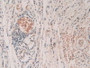 DAB staining on IHC-P; Samples: Human Stomach Cancer Tissue.